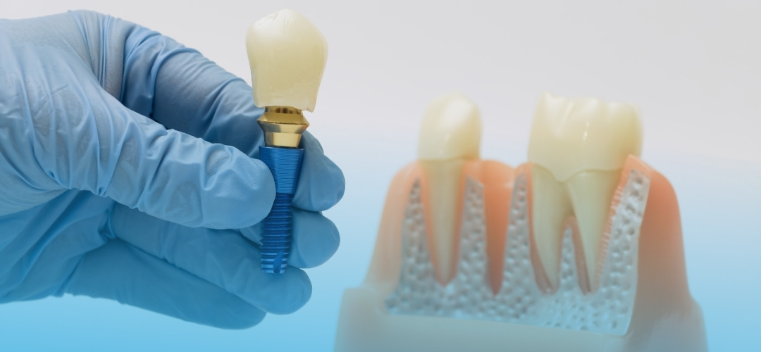Dental İmplant Nedir? Eksik Dişler İçin Kalıcı ve Doğal Çözüm