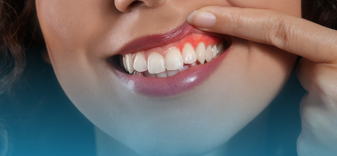 Diş Eti Hastalıkları (Periodontoloji) Nedir? Sağlıklı Diş Etleri İçin Tedavi Yöntemleri