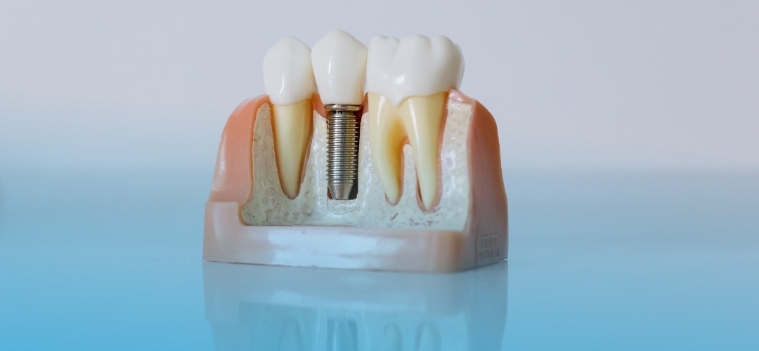İmplant Sonrası Bakım Nasıl Olmalı? İyileşme Sürecinde Dikkat Edilmesi Gerekenler