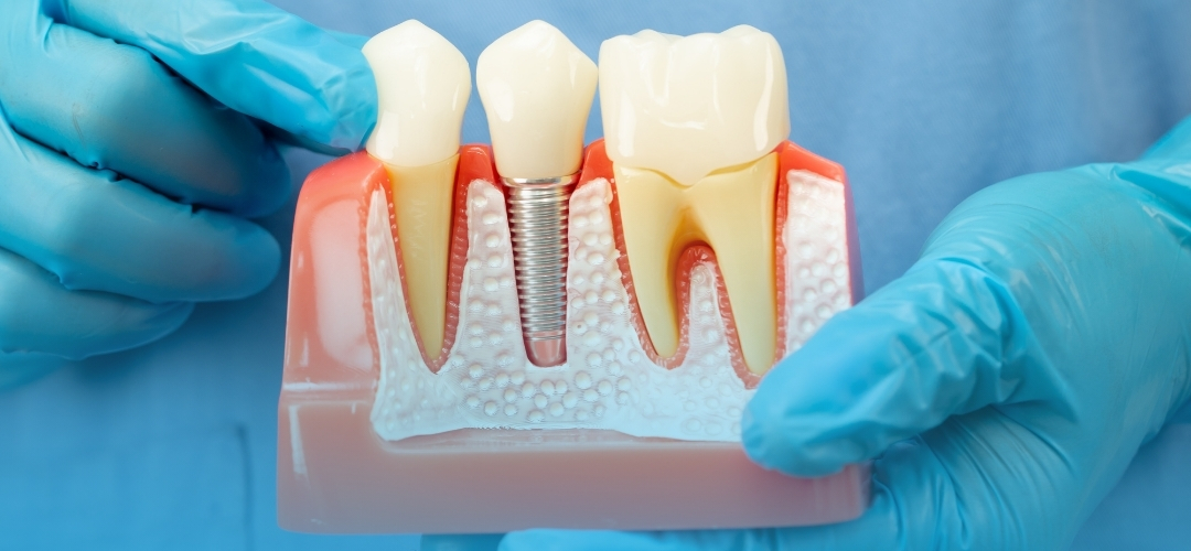 İmplant Tedavisi Süreci Nasıl İlerler? Adım Adım İmplant Uygulaması