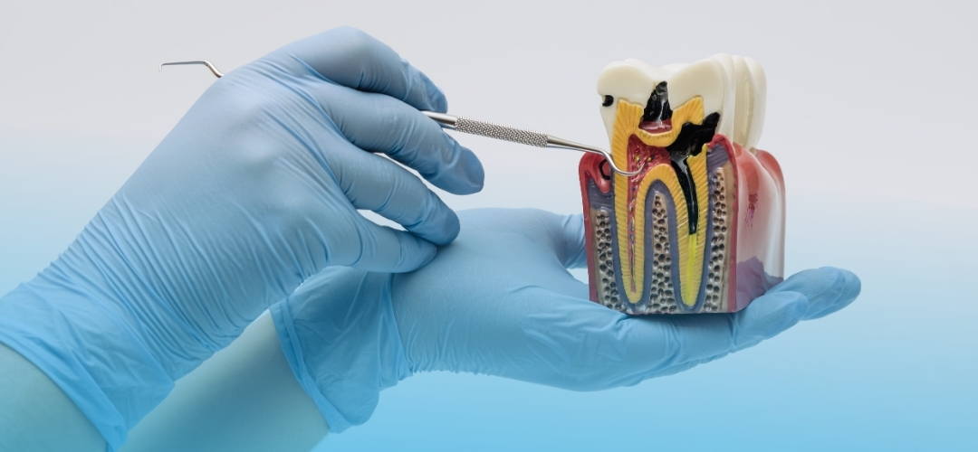 Kanal Tedavisi (Endodonti) Nedir? Dişinizi Kurtaran Tedavi