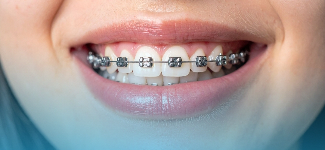 Ortodonti (Diş Teli) Tedavisi Nedir? Düzgün ve Sağlıklı Dişler İçin Çözüm